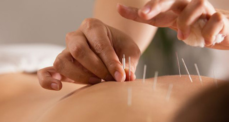 Acupuncture for Hot Flashes: What You Need to Know